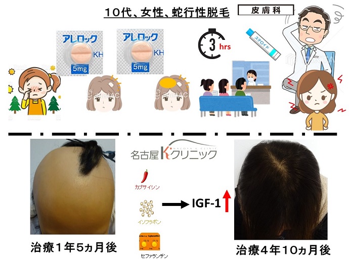 円形脱毛症　病院